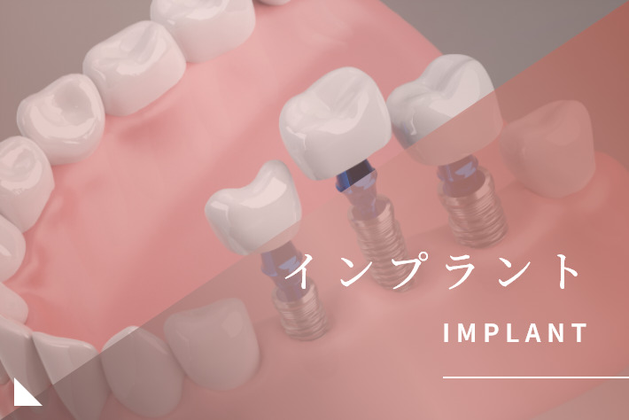 インプラント｜岡崎市の歯医者